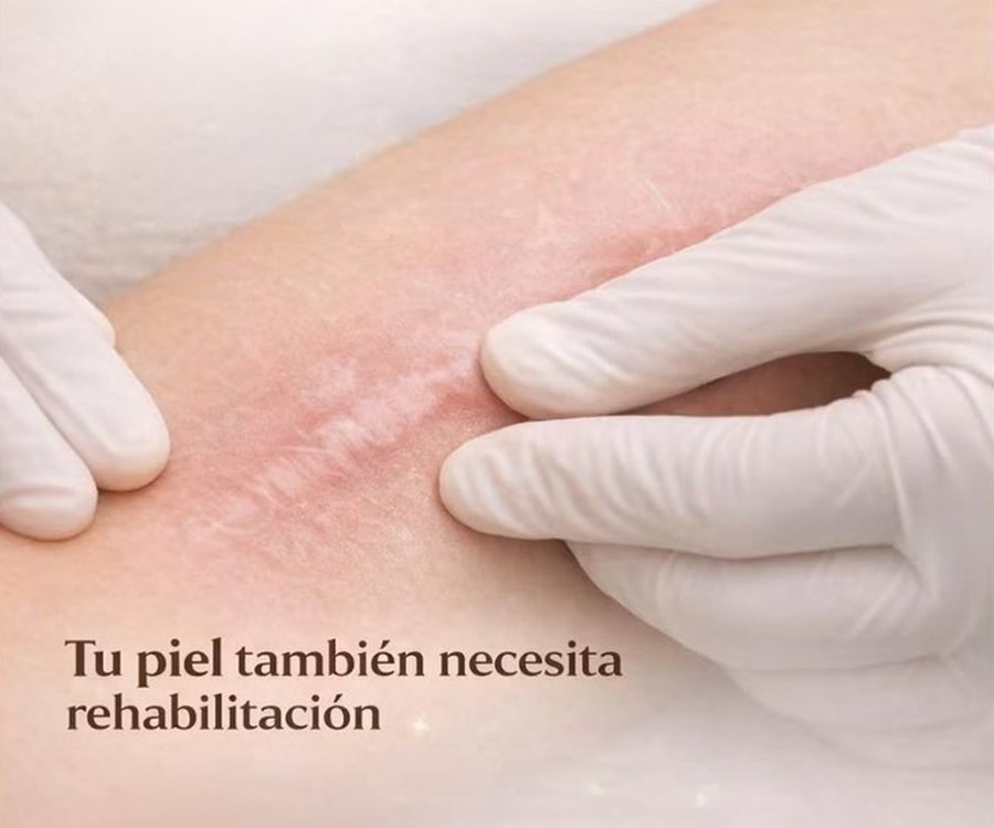 Fisioterapia dermatofuncional para cicatrices y fibrosis
